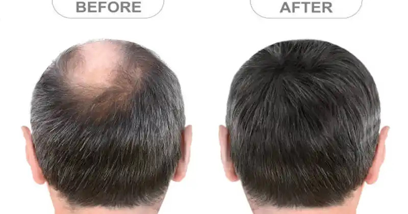 Revitalize Your Hair with Natural Potato-Based Treatments