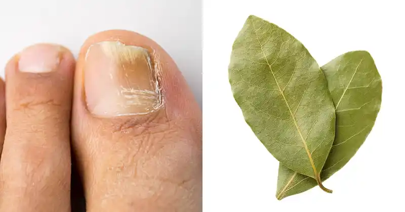Natural Remedies for Nail Fungus…